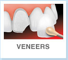 gallery/veneers