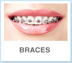 gallery/braces